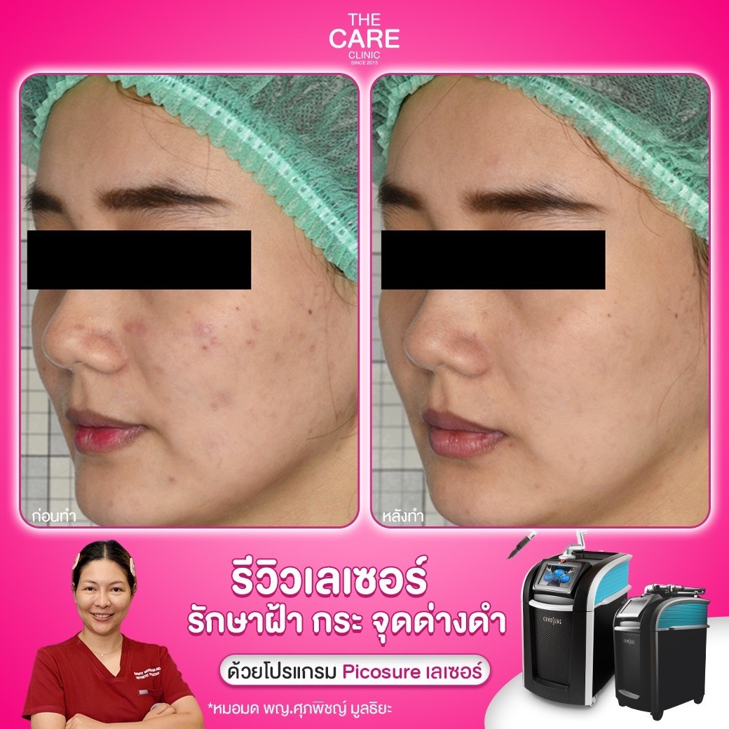 LINE_ALBUM_รีวิวpicosureเคส บริ_250110_1