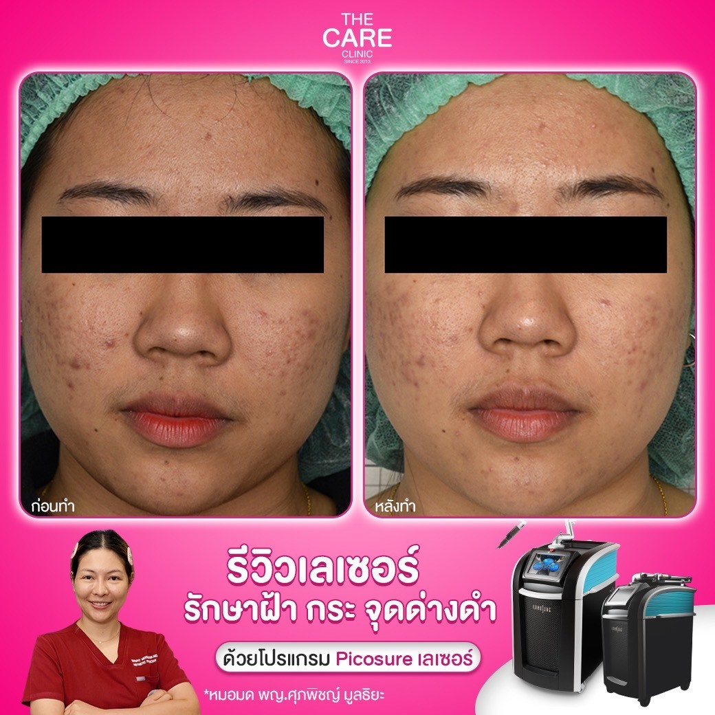 LINE_ALBUM_รีวิวpicosureเคส บริ_250110_2