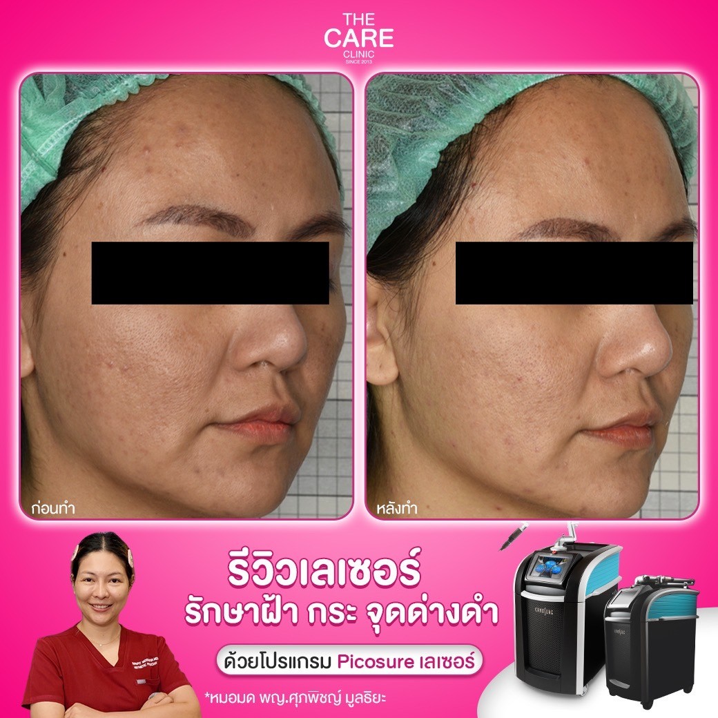 LINE_ALBUM_รีวิวpicosureเคส บริ_250110_3