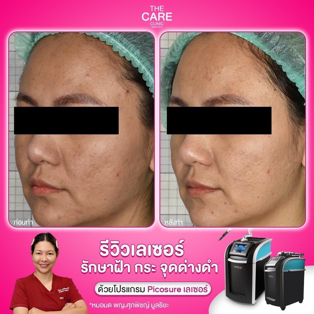 LINE_ALBUM_รีวิวpicosureเคส บริ_250110_4