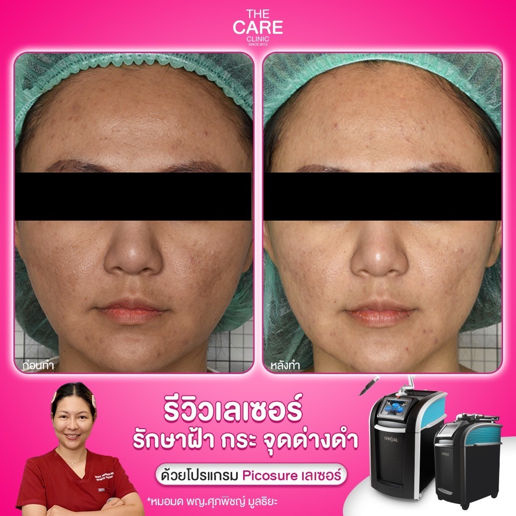 LINE_ALBUM_รีวิวpicosureเคส บริ_250110_5