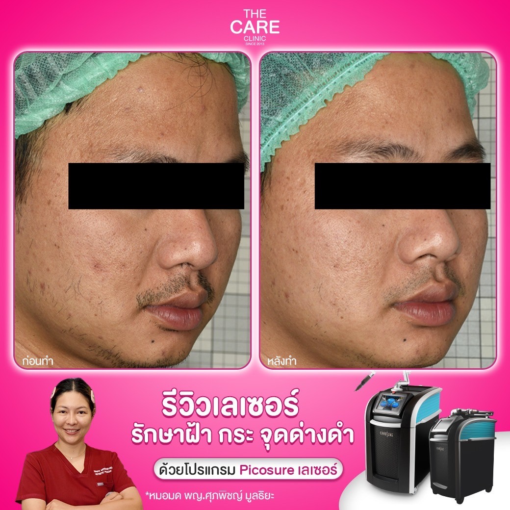 LINE_ALBUM_รีวิวpicosureเคส บริ_250110_7