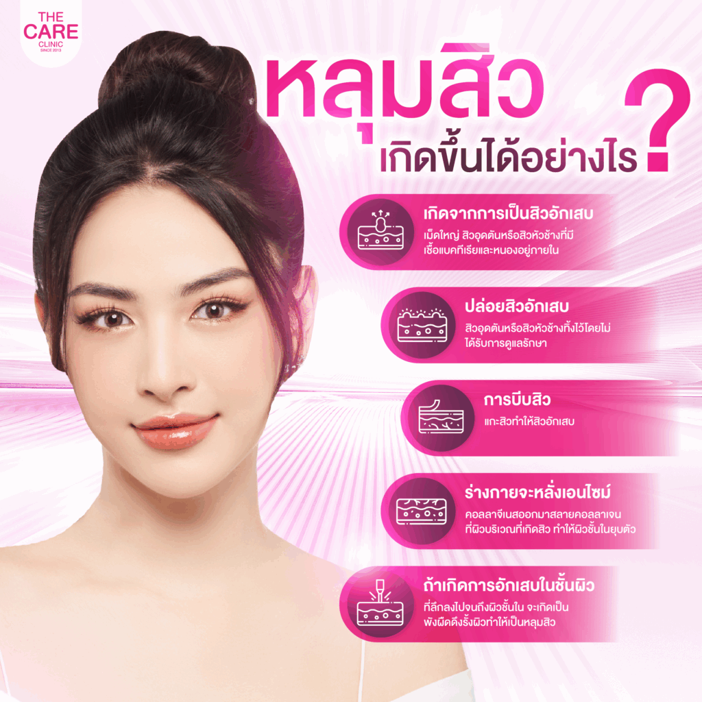 รักษาหลุมสิว