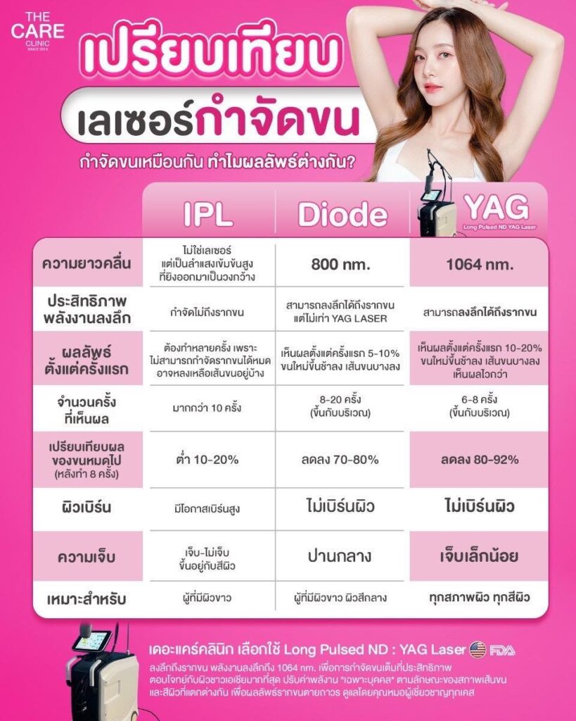 เลเซอร์กำจัดขน