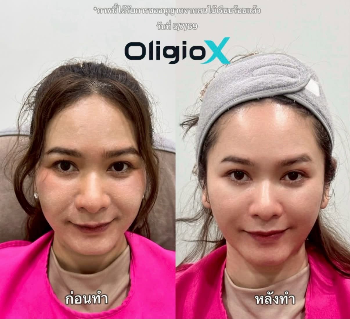 Oligio X
