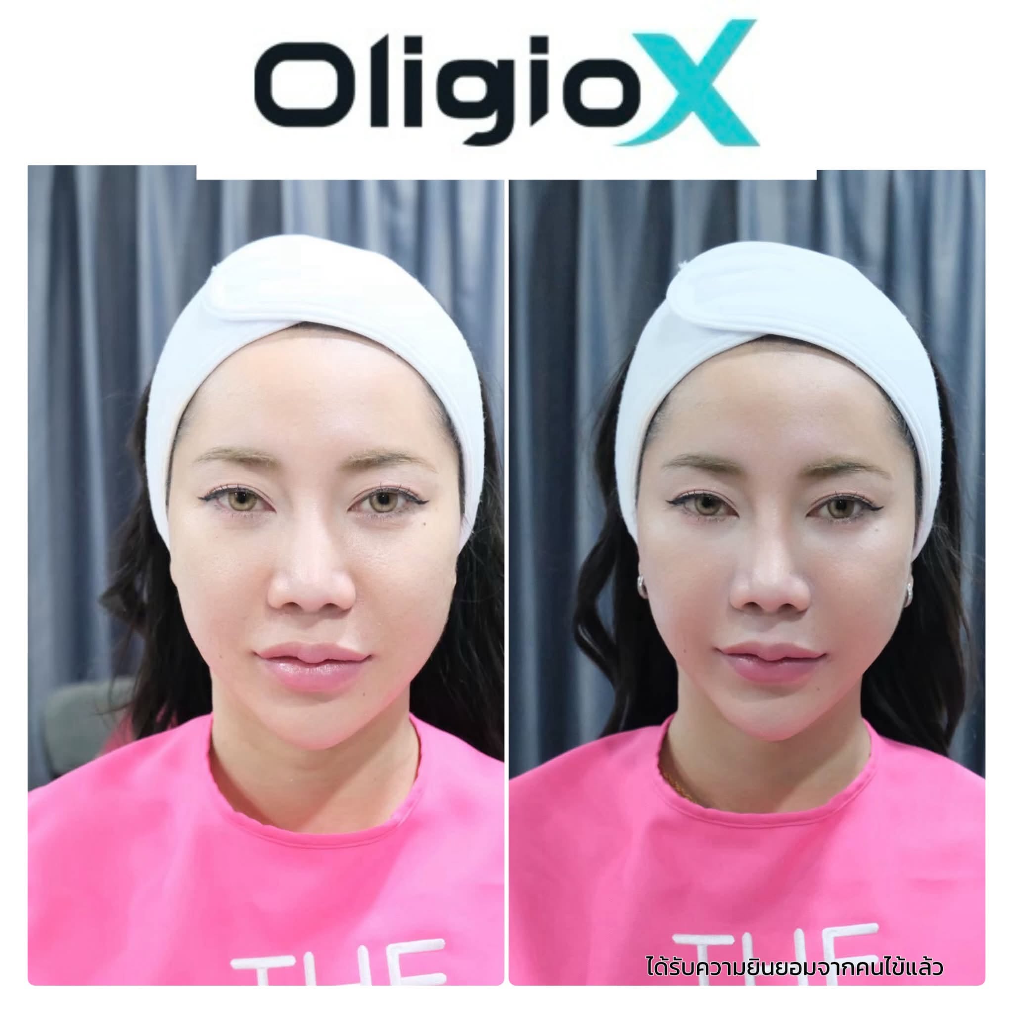 Review-oligio X